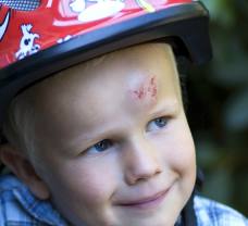 Fejsérülések és fejsebek gyermekeknél